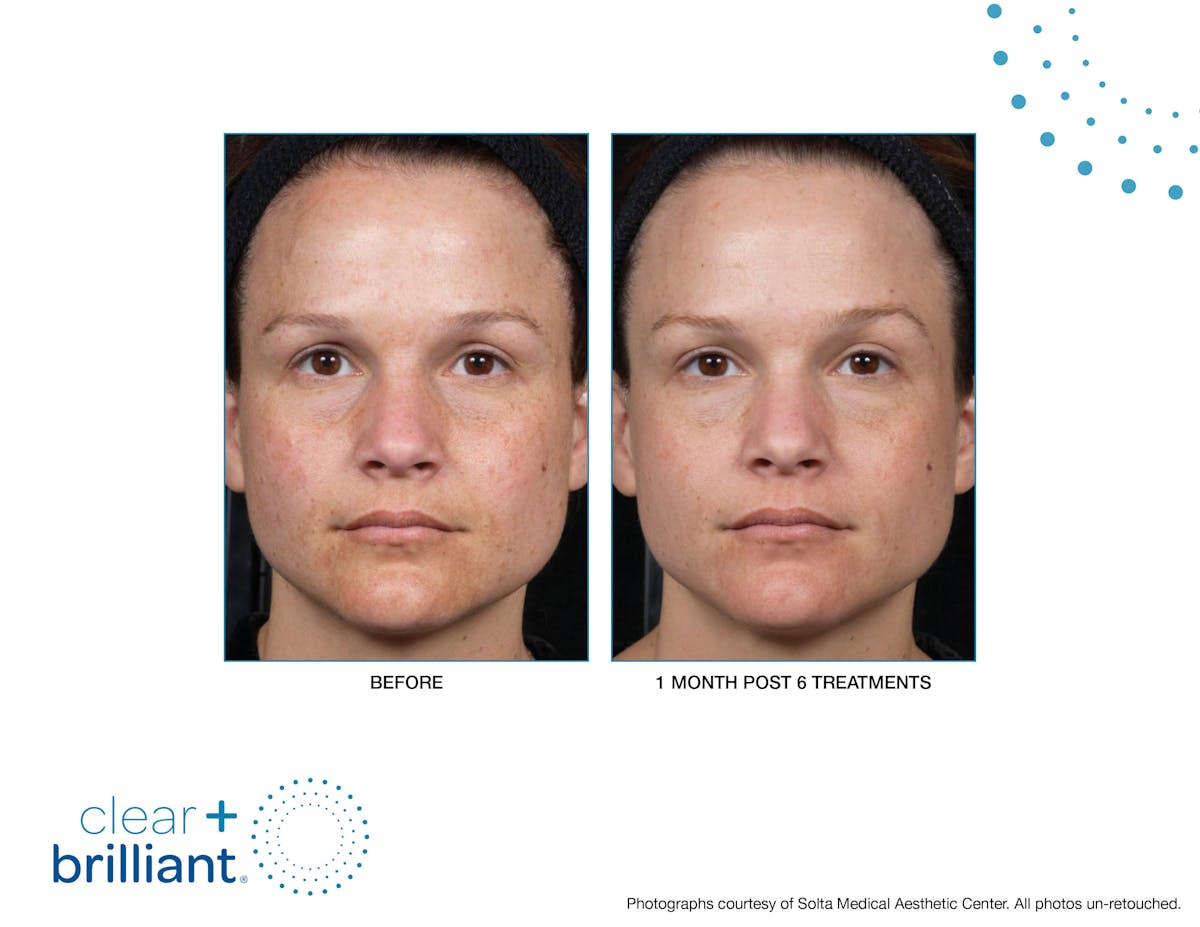 Clear + Brilliant Gallery Before & After Gallery - Patient 955708 - Image 1