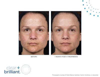Clear + Brilliant Gallery Before & After Gallery - Patient 955708 - Image 1