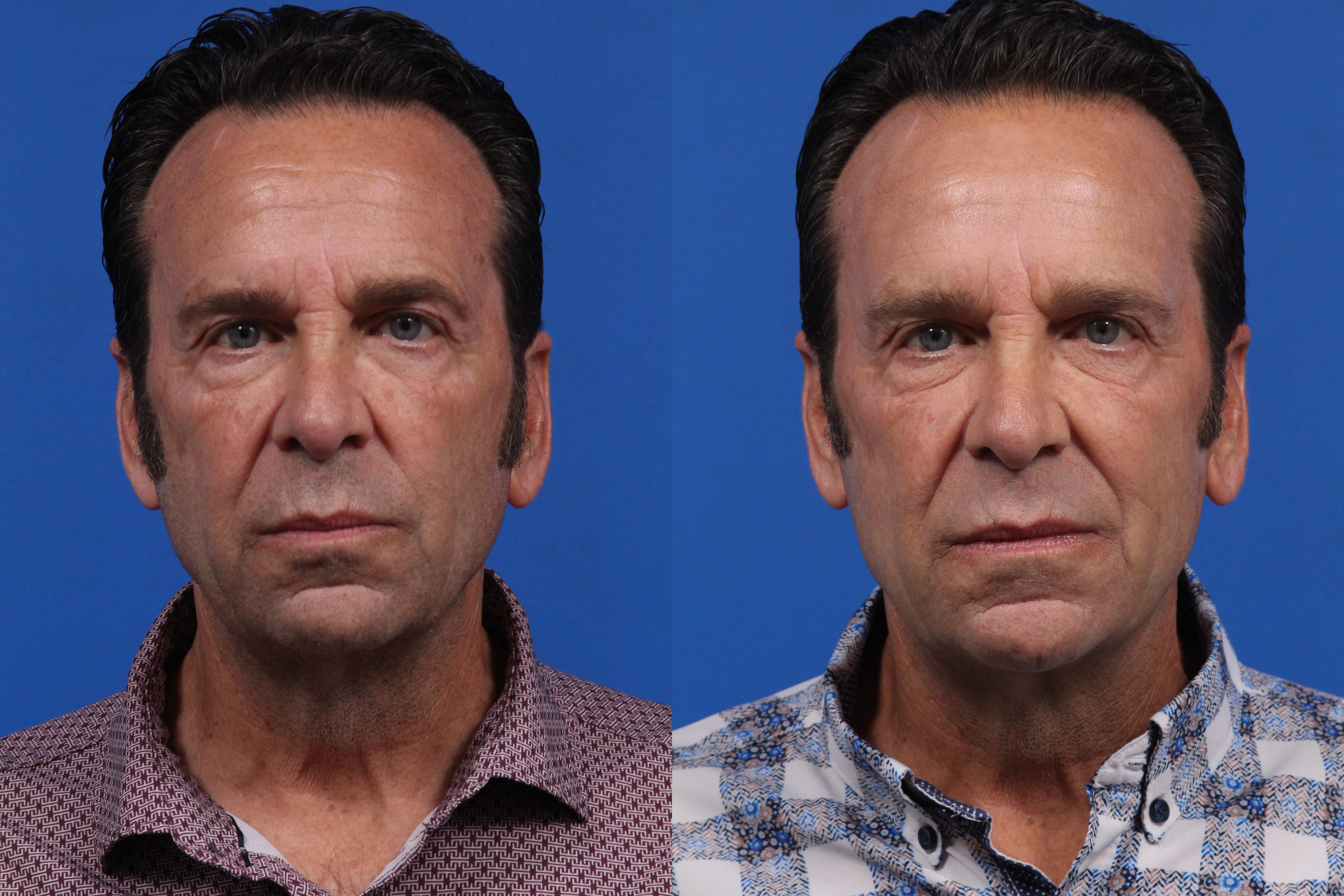BBL Hero Gallery Before & After Gallery - Patient 582880 - Image 1