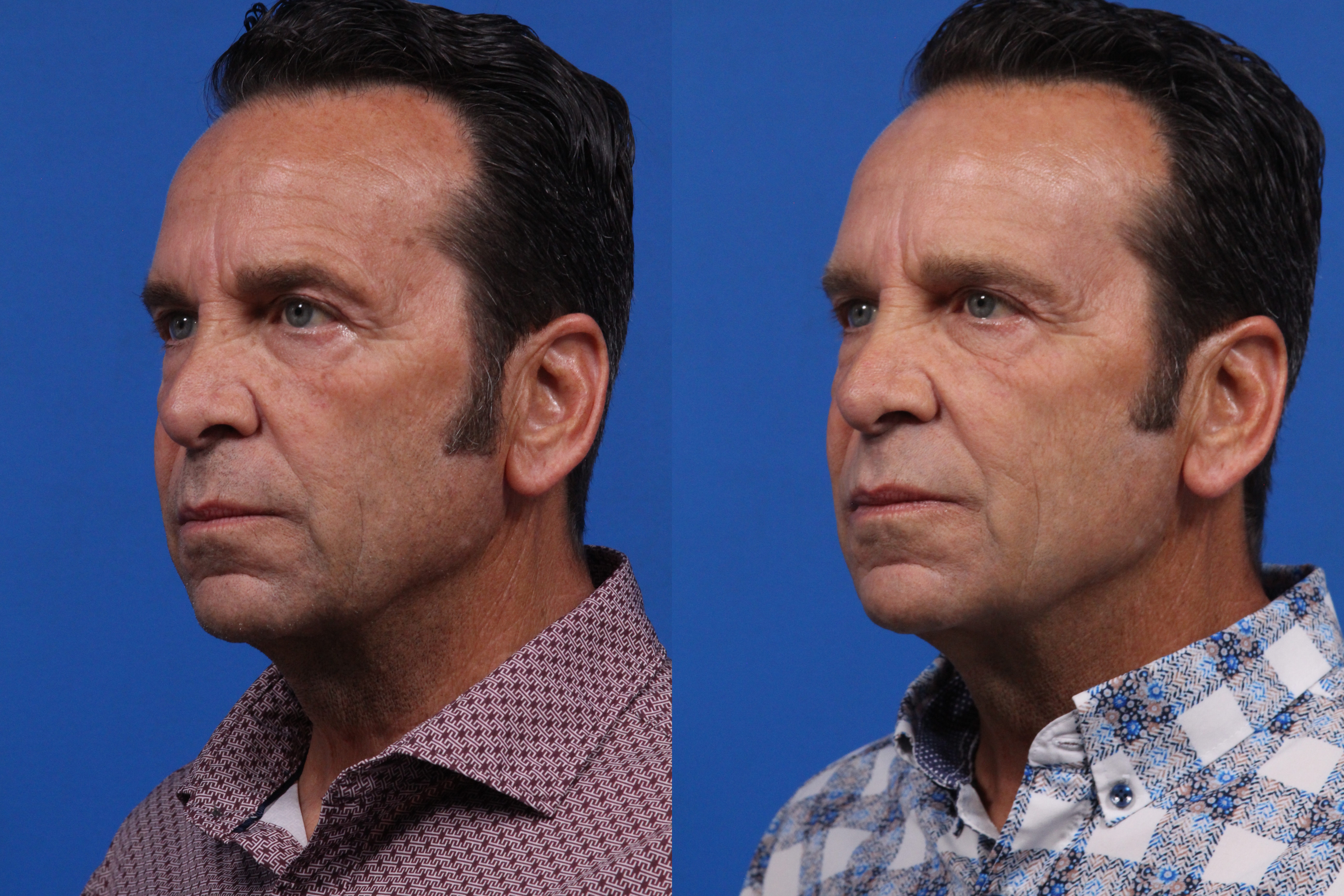 BBL Hero Gallery Before & After Gallery - Patient 582880 - Image 2