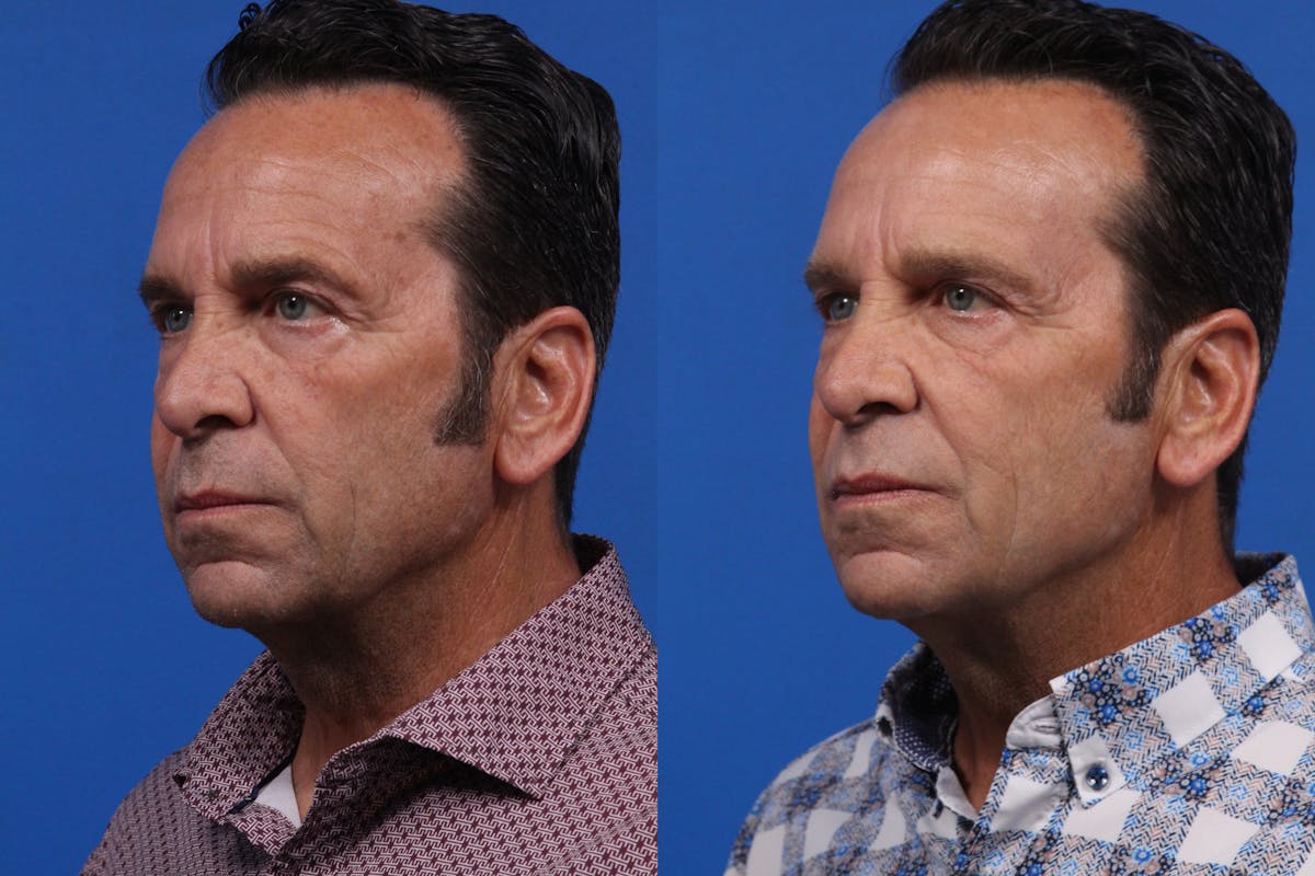 XERF Gallery Before & After Gallery - Patient 215296 - Image 1