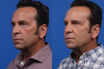 BBL Hero Gallery Before & After Gallery - Patient 582880 - Image 2