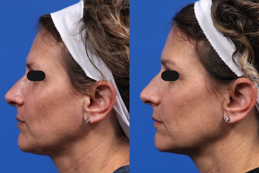 Microneedling Gallery Before & After Gallery - Patient 137024 - Image 2