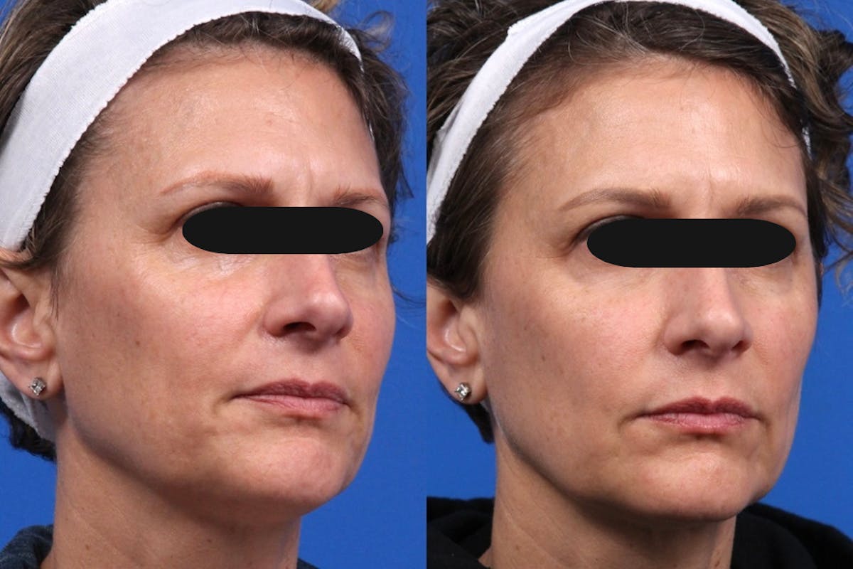 Microneedling Gallery Before & After Gallery - Patient 137024 - Image 1