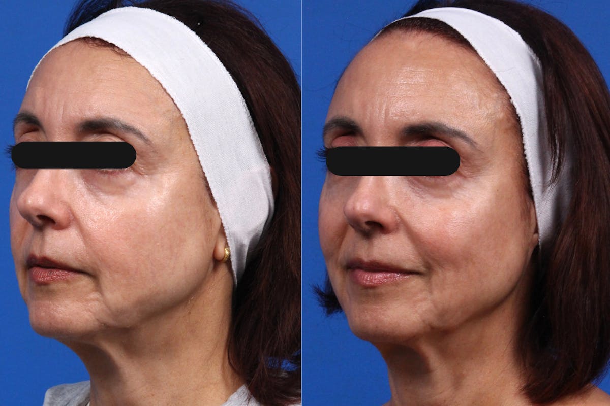 Microneedling Gallery Before & After Gallery - Patient 376304 - Image 1