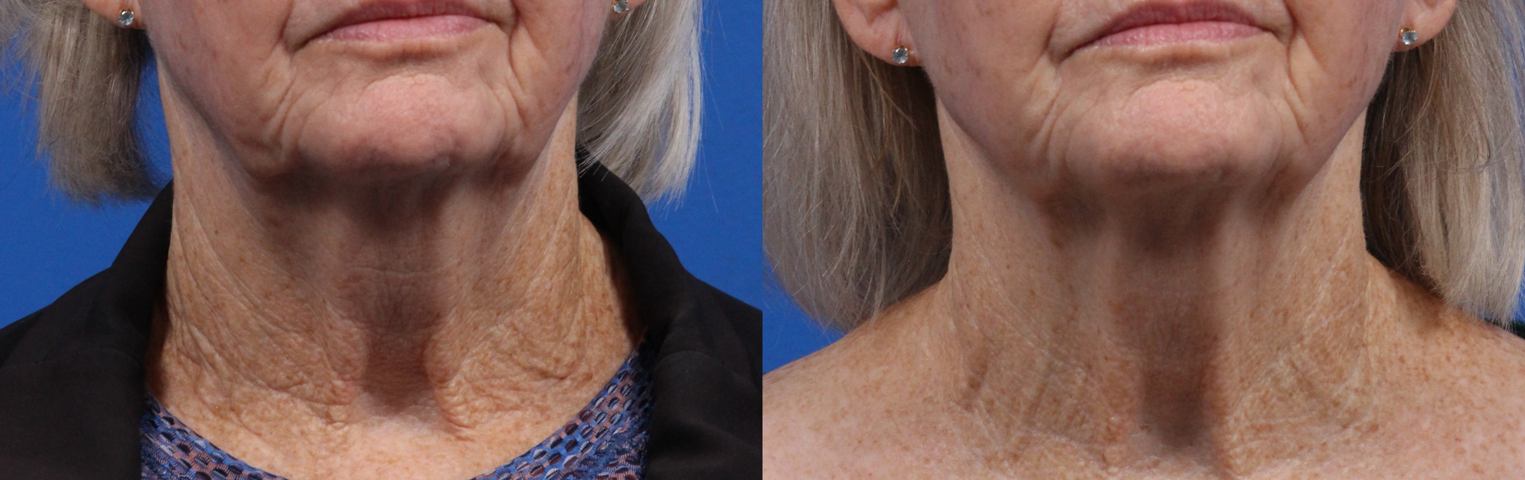 XERF Gallery Before & After Gallery - Patient 417805 - Image 1