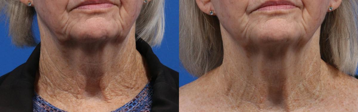 XERF Gallery Before & After Gallery - Patient 417805 - Image 1