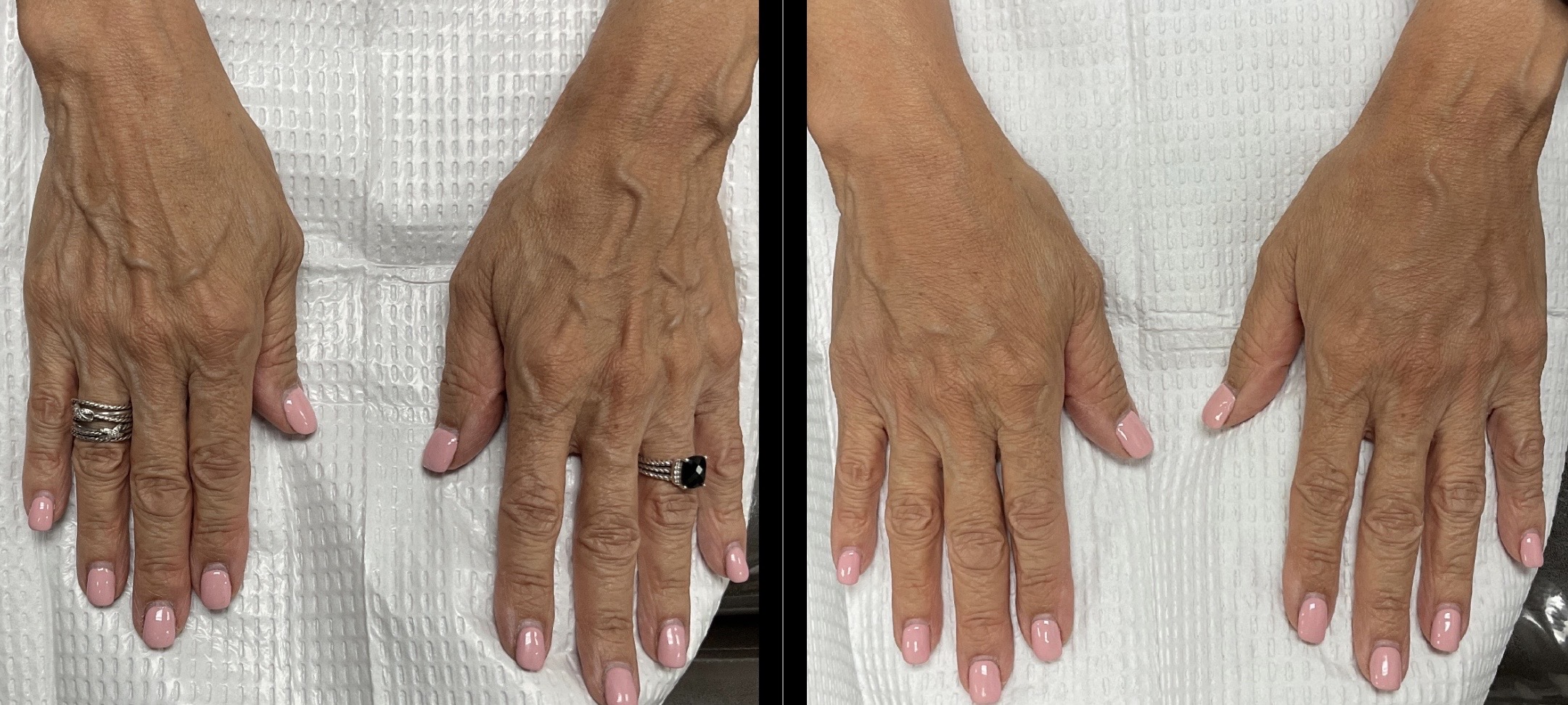 Hand Rejuvenation Gallery Before & After Gallery - Patient 123027 - Image 1