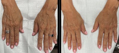 Hand Rejuvenation Gallery Before & After Gallery - Patient 123027 - Image 1
