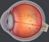 Later view of the eye with floaters