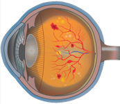 Lateral view of the eye illustrating diabetic retinopathy