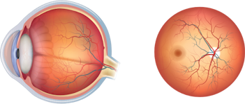 Cross section of the eye and a view of the fundus. Conjunctivitis, Keratitis, Cataract, Floaters, Macular Degeneration and Glaucoma highlighted in the image.
