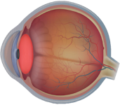 Lateral view of the eye showing a cataract