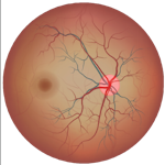 View of the eye highlighting glaucoma