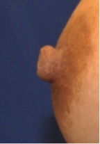Nipple Reduction 2B