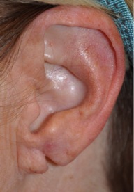 Los-Angeles-Ear-Lobe-Repair