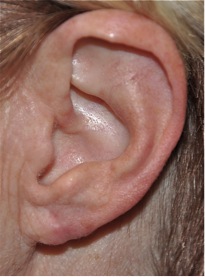 Los-Angeles-Ear-Lobe-Repair-2