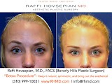 Raffi Hovsepian, MD Blog | Let’s Talk BOTOX® Cosmetic!