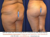 Raffi Hovsepian, MD Blog | True Beverly Hills Buttock Transformation!