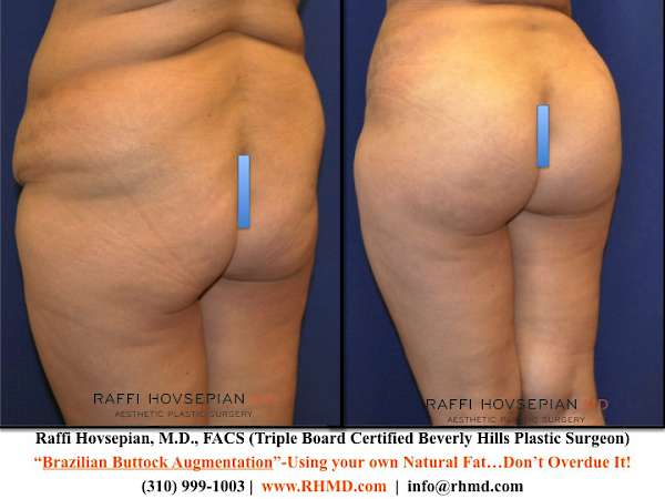 Brazilian Butt Lift in Fresno,CA  Athēnix Advanced Plastic Surgery