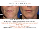 Raffi Hovsepian, MD Blog | Pucker Up (Lip Augmentation)!