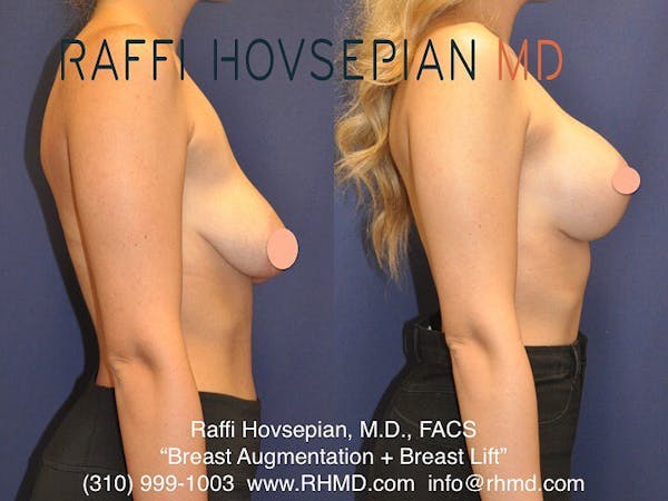 Breast Lift
