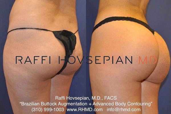Butt Augmentation