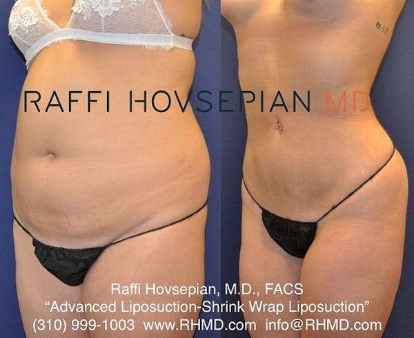 Shrink Wrap Liposuction