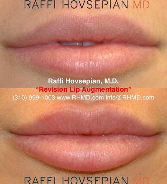 patient before and after lip augmentation 3