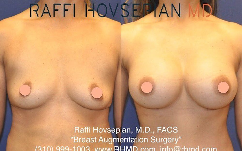 breast augmentation before and after front view 5