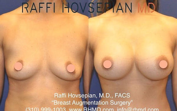 Breast Augmentation