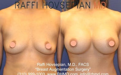 breast augmentation before and after front view 5