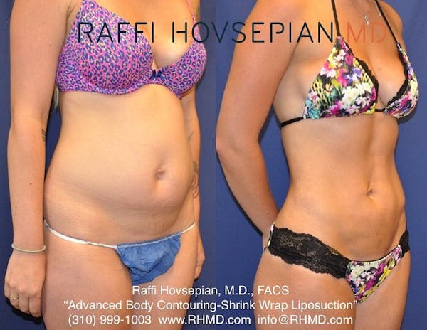 Procedures Before & After Gallery - Patient 40413565 - Image 1