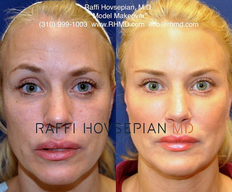 patient before and after front view of model makeover