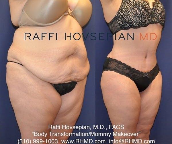 Tummy Tuck