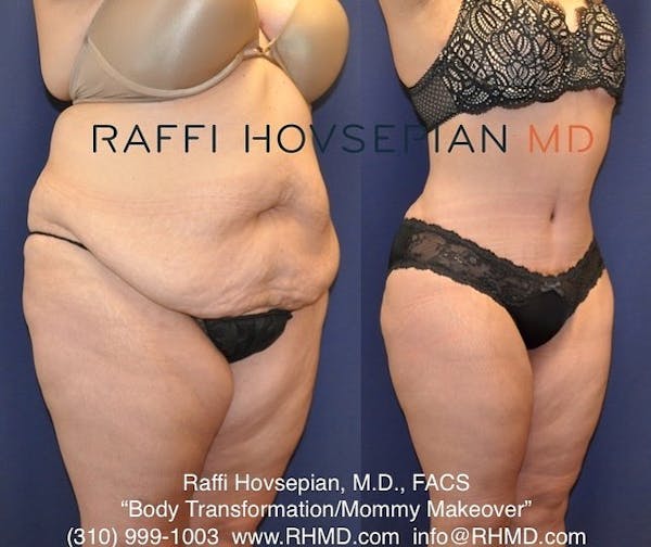 Tummy Tuck in Beverly Hills  Abdominoplasty by Dr. Raffi Hovsepian