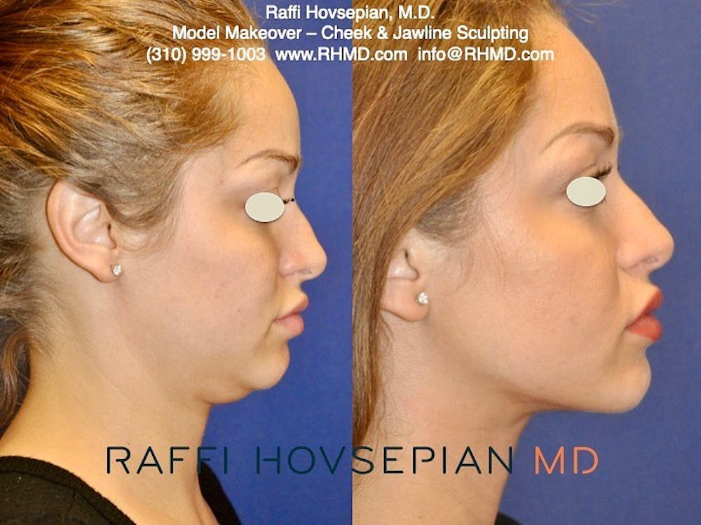 Procedures (old) Before & After Gallery - Patient 74399738 - Image 1