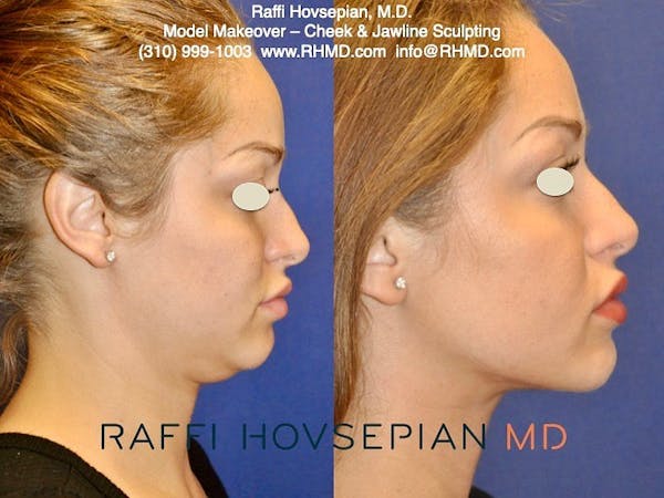 Procedures Before & After Gallery - Patient 74399738 - Image 1
