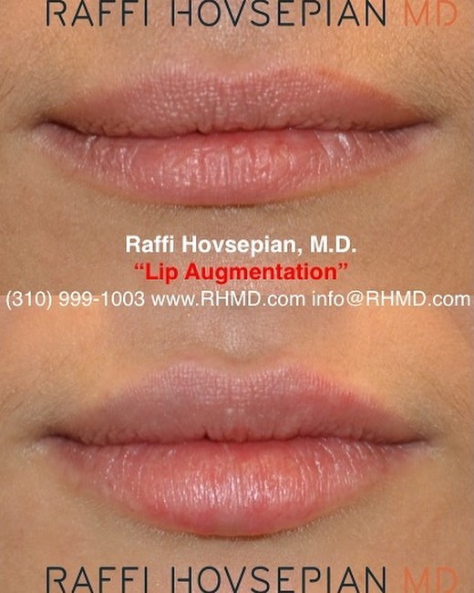 patient before and after lip augmentation 2