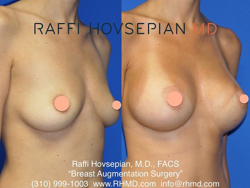 Procedures Before & After Gallery - Patient 74399824 - Image 1