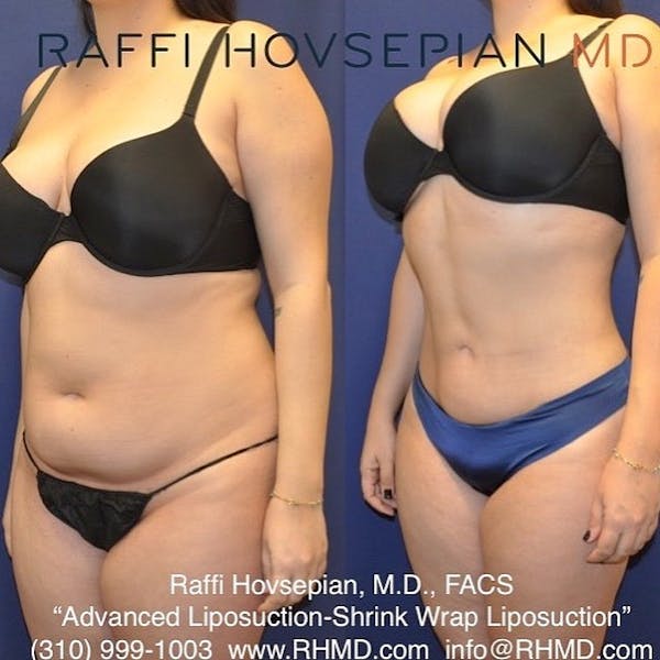 Procedures Before & After Gallery - Patient 74399826 - Image 1