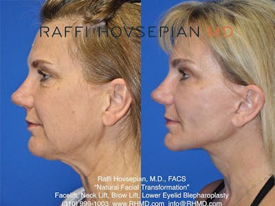Procedures Before & After Gallery - Patient 189892931 - Image 1