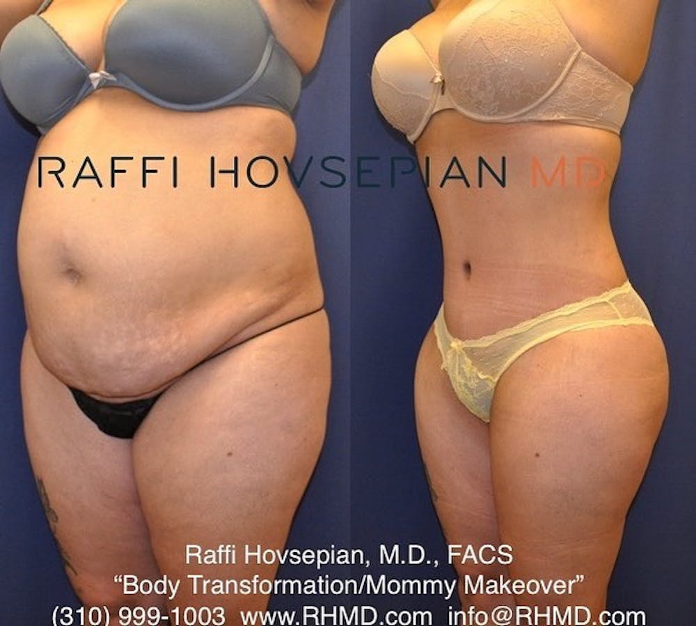 Procedures (old) Before & After Gallery - Patient 74399829 - Image 1