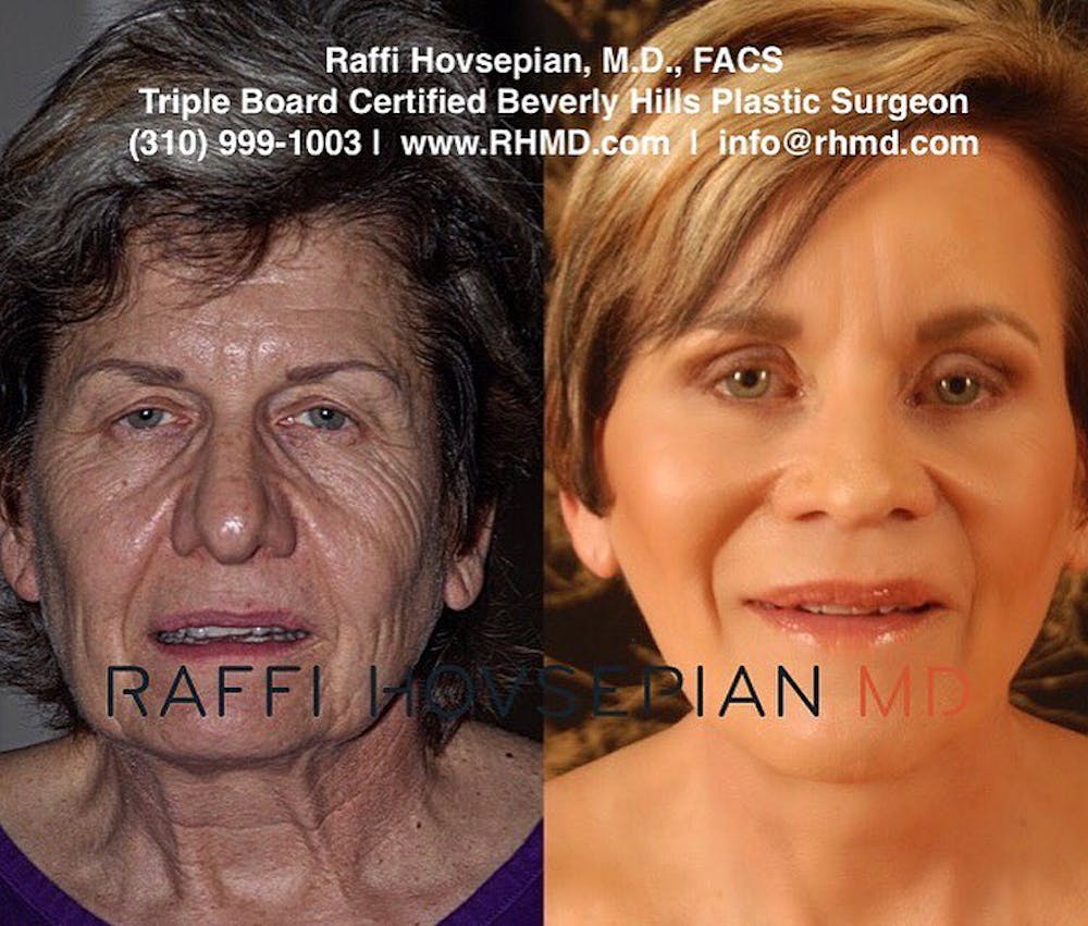 Procedures (old) Before & After Gallery - Patient 74399851 - Image 1