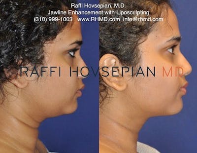 Procedures Before & After Gallery - Patient 74399853 - Image 1