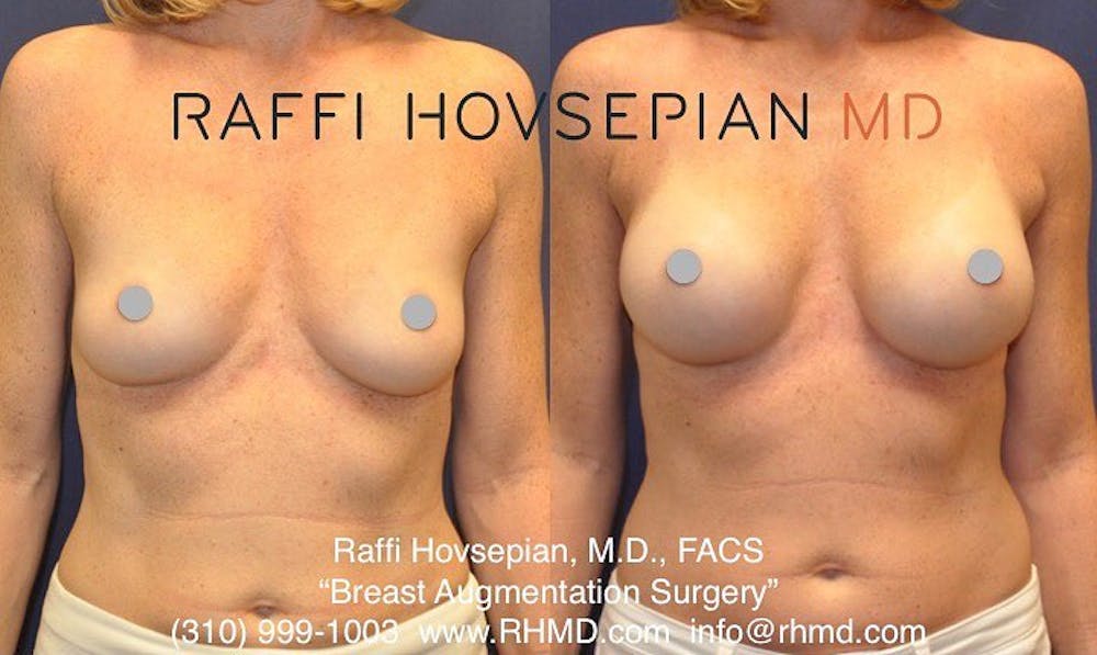 breast augmentation before and after front view 3