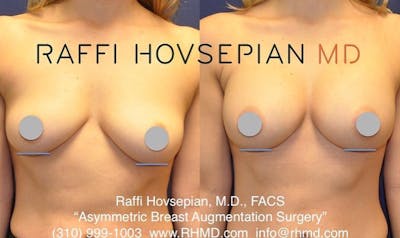 breast augmentation before and after front view 4