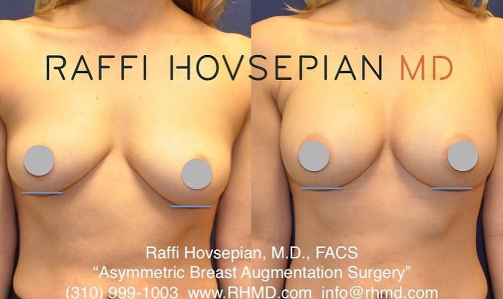 breast augmentation before and after front view 4