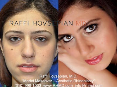 patient before and after of rhinoplasty procedure