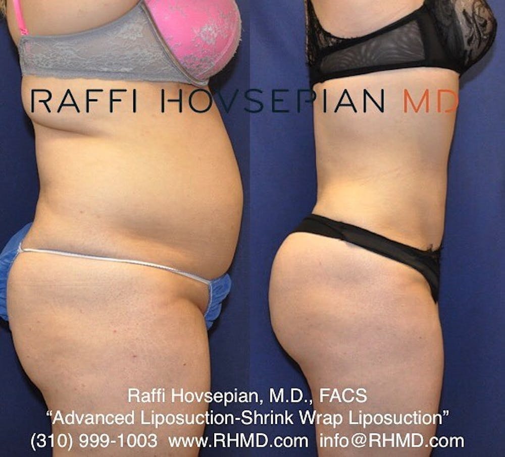 patient side angle before and after of shrink wrap liposuction